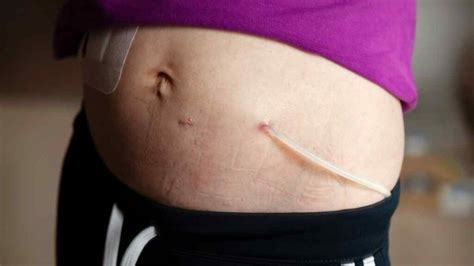 remit cirurgia|PERITONITES .